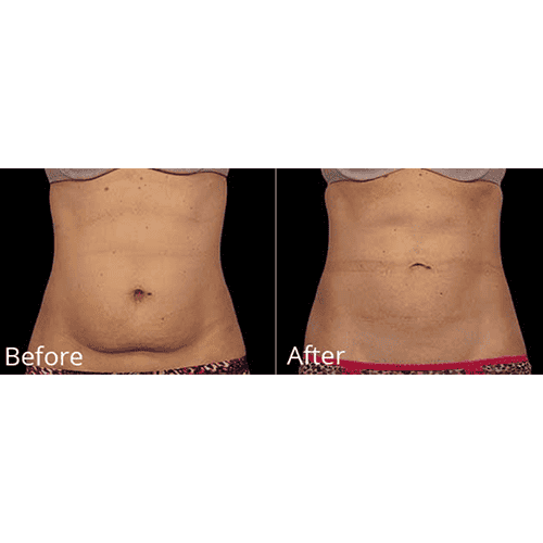 Coolsculpting before after | Willow Med Spa & Salon | Morgantown, WV