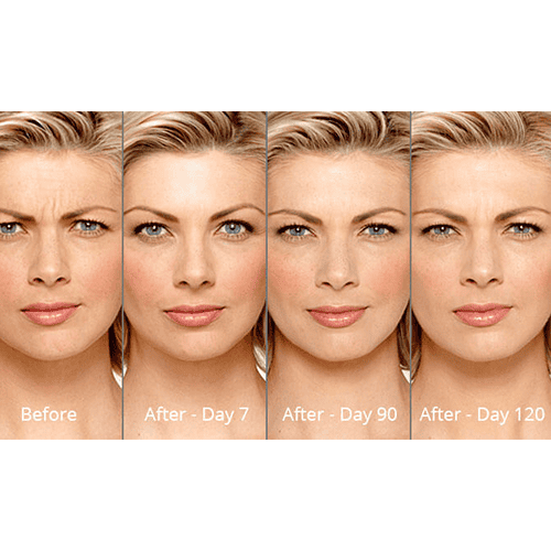 Botox before after | Willow Med Spa & Salon | Morgantown, WV