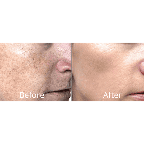 Forever young bbl photofacial before after | Willow Med Spa & Salon | Morgantown, WV
