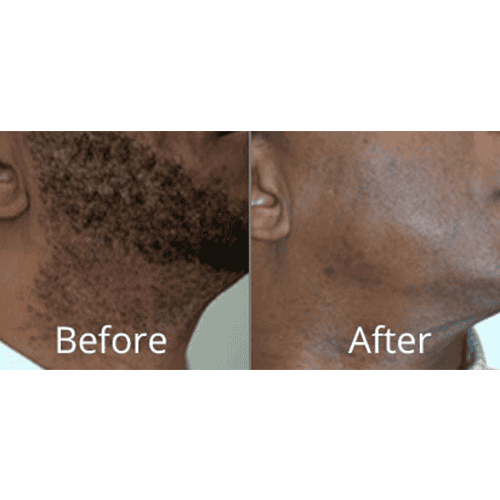Laser hair removal before after | Willow Med Spa & Salon | Morgantown, WV