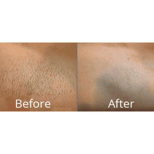 Laser hair removal before after | Willow Med Spa & Salon | Morgantown, WV