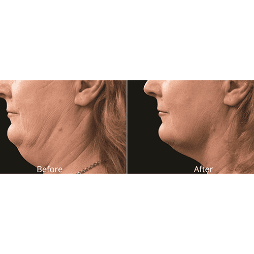 Willow Medspa before after chin coolsculpting | Willow Med Spa & Salon | Morgantown, WV