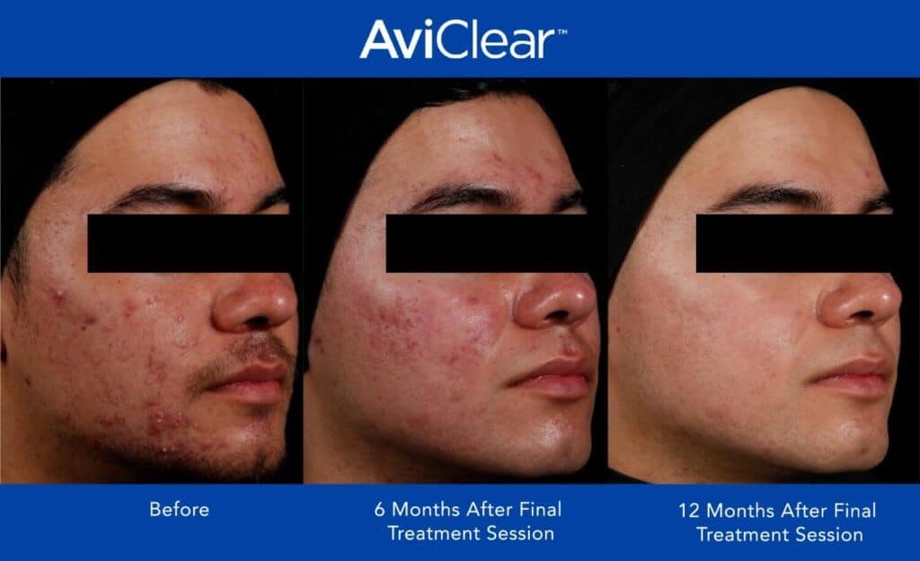 AviClear Before and After _12 month_1