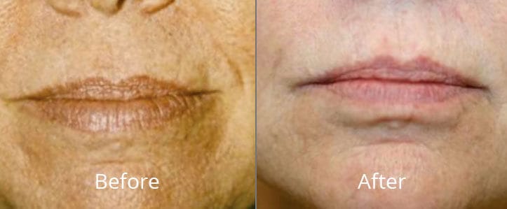 BBL Hero Face and Body Before and After | Willow Med Spa & Salon | Morgantown, WV