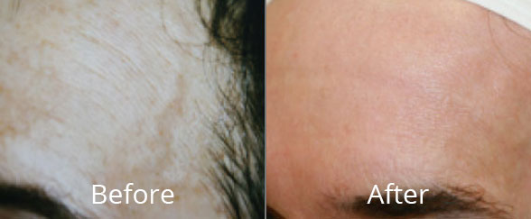 BBL Hero Face and Body Before and After | Willow Med Spa & Salon | Morgantown, WV