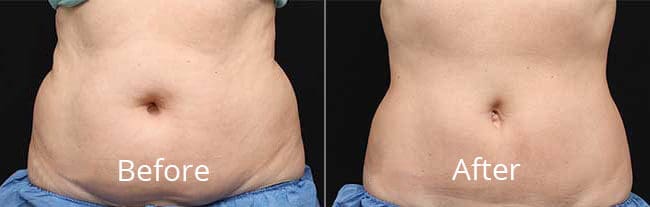 Coolsculpting Before and After | Willow Med Spa & Salon | Morgantown, WV