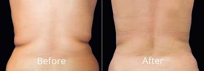 Coolsculpting Before and After | Willow Med Spa & Salon | Morgantown, WV