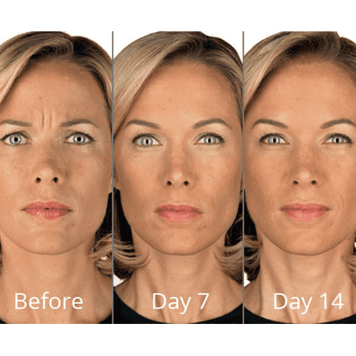 Botox before after | Willow Med Spa & Salon | Morgantown, WV