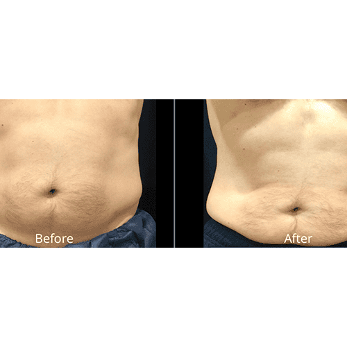 Willow Medspa before after abdominal Male coolsculpting | Willow Med Spa & Salon | Morgantown, WV
