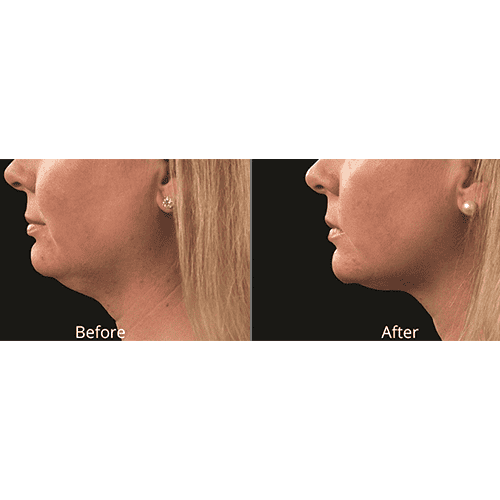 Willow Medspa before after chin coolsculpting | Willow Med Spa & Salon | Morgantown, WV